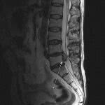 грыжа на МРТ снимке позвоночника